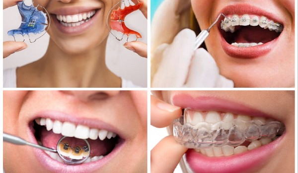 Ile ciekawostek na temat aparatu ortodontycznego wiesz?